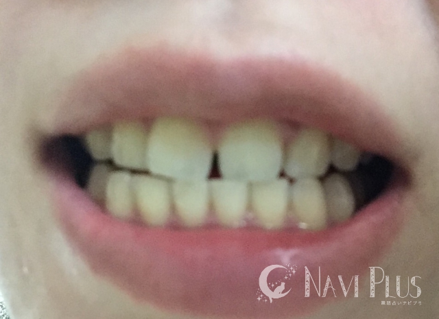 ホワイトニング前の歯は、前歯がB2、犬歯がA3くらい